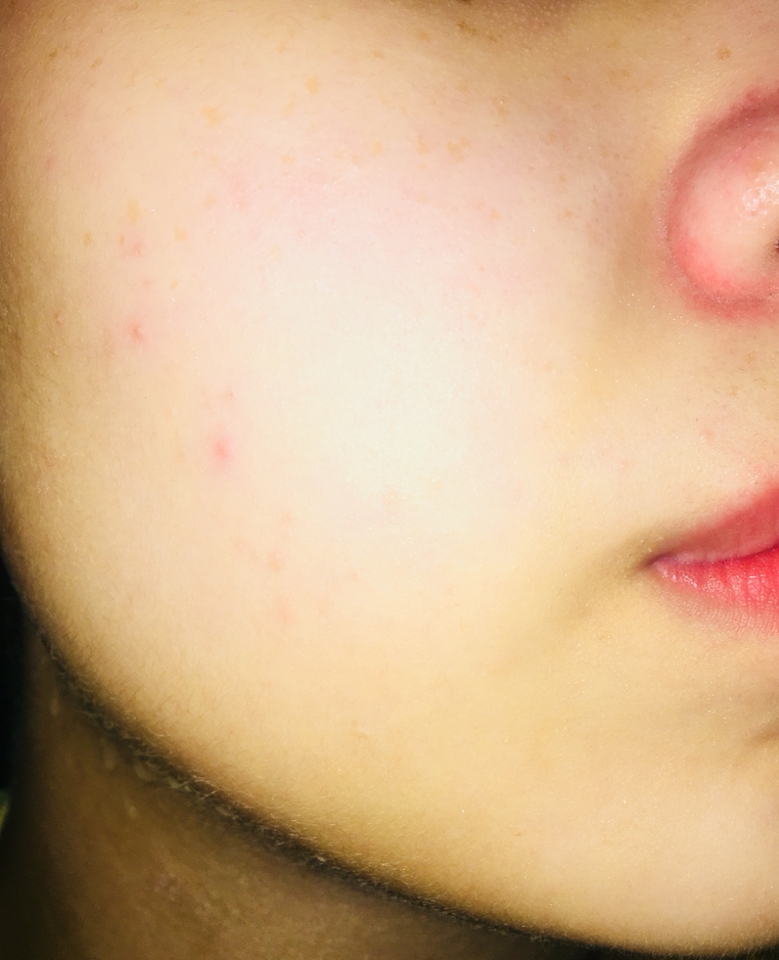 씻어낸후에 얼굴 안색이 밝아졌고 피지가 다 없어지지는 않았지만 하기 전보다는 많이 없어졌고 피부에 시원함이 오래가더라구요!👍🏻여름에 쓰기 좋은 팩인것같아요!