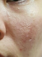 
이게 제작년인가 피부인데
놀라운 건 이것도 케어로 좋아진 상태였다는 거예요.
이 전에는 까만 여드름 흉터+붉은흉터+화농성여드름+좁쌀여드름이 종류별로 모여있어서 옛날이라 사진은 없는데
딱 이거보다 2배 심각했어요.
#아벤느 온천수 미스트 대용량으로 30통인가 쓴 새럼
🙋🙋🙋


🚫🚫🚫🚫🚫🚫🚫🚫

그 정도 수준일 땐 다른 거 다 제쳐두고
제가 소개해드렸던 팩중
불사마스크랑 쑥마스크 1일1팩 피부주기 2주마다 한 2~3일 쉬어주고 매일 했고
무조건 #아벤느온천수미스트 -  #EGF 성분 앰플을 #mts롤러 와 매일 사용했어요!

그 땐 왠만한 진정제품들이 효과가 있든 없든 티도 안 나는 단계라 #녹차물 로 팩하거나 #아벤느온천수미스트 스킨팩 자주자주 해주고 #EGF앰플 과 #MTS롤러 + 진정팩에만 올인했어요.

겨울에는 크림도 재생크림, 또는 볼륨톡스도 가끔 사용해줬습니다.
기본적으로는 위의 방법만 사용했어요 거의.

🚫🚫🚫🚫🚫🚫🚫🚫



진짜 그 땐 화장이고 뭐고 그냥 아예 뭘 하기가 힘든 피부고 화장하면 더 지저분한 피부였거든요.
가리자면 어느정도 가릴 수는 있는데 그럼 너무 두꺼워서 악순환이라….

그래서 되도록 화장도 안 했고
mts롤러는 암거나 상관없구 egf 앰플도
특별히 유해성분 없고 안 맞는 성분 없고 EGF 함량 많은 걸로 쓰심 돼요.
사진만큼 회복도 1년~2년 정도 걸렸어요.

모공은 피부과 레이저 때문에 패인모공이지만 이 조합으로 해서 저만큼 나아진 거랍니다ㅋㅋㅋ

진짜 그 시기에 egf 의 중요성을 뼈저리게 느꼈다죠….
저는 이런 디바이스 많이 써보구 민감성 수치 1나온 피부라 mts롤러도 강도만 다르게 하고 매일 했는데 보통은 한 이틀하고 3일 쉬고 아님 하루이틀 걸러 사용하셔야 해요!
아님 피부 예민해질 수도? 뭐든 과유불급!

