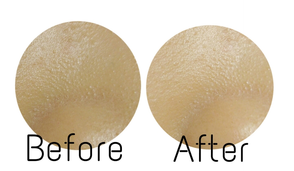 코 옆 모공끼임이나 볼부분의 피지들이 눌려 정리된 것 같은 느낌이죠?