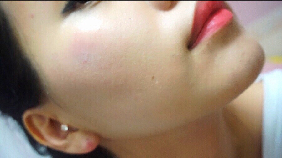 레브론 컬러스테이 파운데이션 바른 후 
오오~~ 두드러기난 부분이 많이 커버되네요
손등에 발랐을 땐 핏줄이 비춰서 커버력이 좀 떨어지나 싶었는데 피부에 발라보니 또 다르네요
얇게 발리는 듯 싶은데 또 커버력은 좋아요, 

세안하고 스킨-세럼만 바르고 파운데이션을 발라봤는데
아무래도 지성피부에 적합한 타입이라 그런지 
건조해서 살짝 뜨더라구요
기초제품 탄탄하게 바르고 파운데이션 발라주면 
괜찮을 것 같아요!


