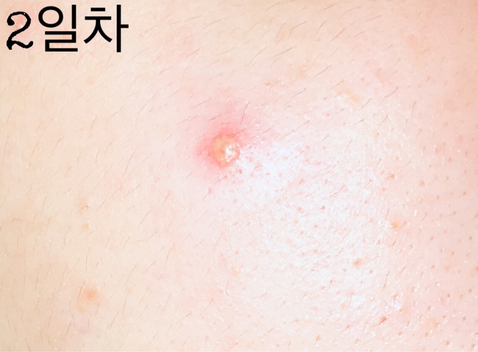 패치를 제거해보니 트러블 농이 한 부분에 집중적으로 모여있었어요