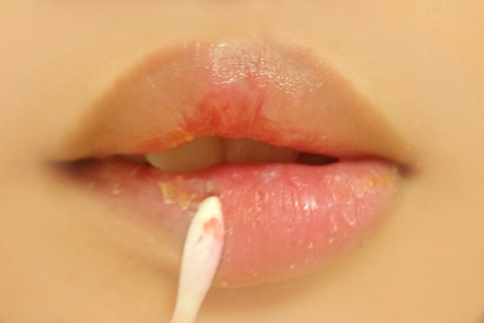 2.면봉으로 쓱쓱 밀기
저는 이방법을 두번을거쳐서 했어요!! 넘쎄게하면피가 나올수있으니 조심조심!!
 갠적으로 손으로 각질을 하나하나떼는것보다 이방법이 입술을 더망치지않는듯해요!