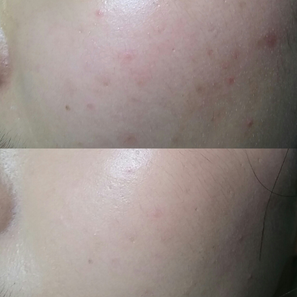 제 심각한 여드름 흉터도 가려볼게요 ..! 볼은 그냥 대부분의 파운데이션도 가려지기에 어느정도 커버력은 있구낭 했숩키당..😙😙