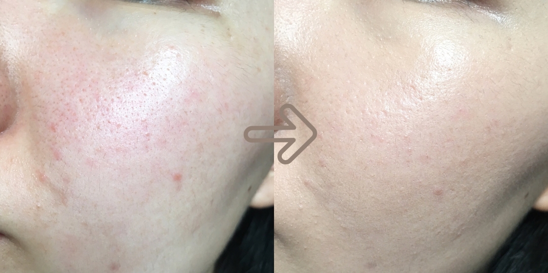 (이 사진에서는 자연광으로 촬영 중 갑작스런 먹구름으로 색상이 더 어두워져 보이니 커버력만 봐주세요)

요즘 제 피부는 왜 때문인지 각종 여드름과 붉은기, 잡티, 모공으로 고생중이에요ㅠㅠ 



그 중에서도 가장 고민인 부분이 붉은기와 모공이었는데, 모공부각없이 잘 메꿔주고 붉은기도 잘 잡히더라구요!  

진한 잡티들은 한번으로는 힘들었어요