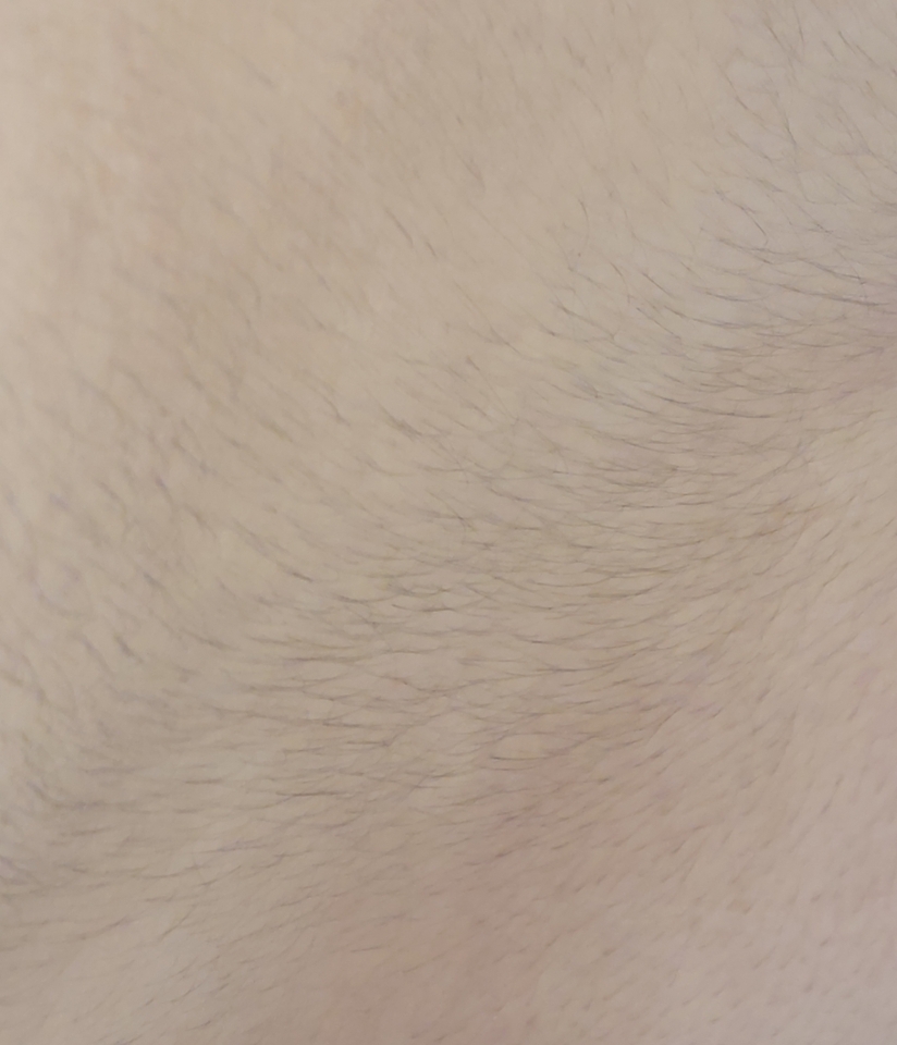 이런 털들이 너무 많이 나있어서 스트레스에요 다른데에도 털이많이나긴하지만 다른데는 면도를 하면 되는데 등 쪽은 면도하기에도 까다롭잖아요...ㅠㅠㅠ 혹시 등쪽 털제거는 어떻게 해야하나요..ㅠㅠ