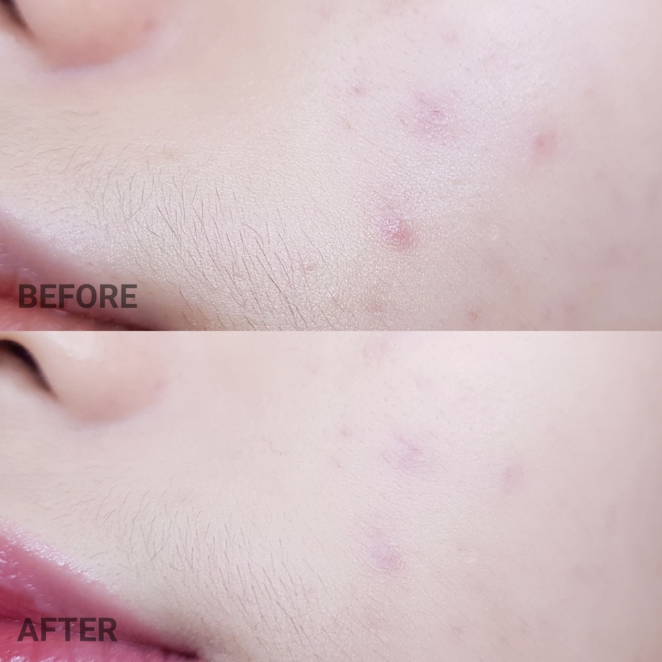 저는 색상이 노랑 빛이 많이 돌 줄 알았는데 완전 상아빛이라서 심하게 누렇지도, 핑크끼가 많이 돌지도 않더라고요. 근데 또 회끼는 없음....
그래서 웜톤 쿨톤 뉴트럴톤, 톤 가릴 것 없이 그냥 내 피부톤이 21호다 하시면 아이보리 컬러 사용하시면 될 것 같아요!
색상까지 우수한 쿠션이라서 손이 자주 가게 되더라고요...
왜 베이스는 에스쁘아만 찾는지 알 것 같아요 ㅋㅋㅋㅋㅋ
​
파우더가 필요 없는 완전 무광! 매트! 이런 느낌보다는 겉보속촉의 교과서인 세미매트 제형감이 더 강해서 건성분들은 스킨케어만 잘 하시면 웬만해서는 사용하실 수 있으실 것 같아요.
수부지, 지성은 말해 뭐해...당연히 잘 맞으실 것 같고요!
​
에스쁘아의 프로테일러 라인업 차트를 보시면 비벨벳, 비글로우, 비실크, 비파우더 이렇게 4가지 종류가 있는데
유일하게 커버력 부분에서 [하이] 평가를 받은 쿠션이 비벨벳 쿠션이더라고요.
그정도로 에스쁘아에서 이번 쿠션은 커버력에 온 집중을 쏟아 부은 것 같았어요.
​
에스쁘아 비벨벳 커버 쿠션의 장점을 더 잘 느끼시려면 무조건 커버하겠다고 내용물을 무작정 쌓아 올리는 것 보다는 얇게 조금씩 올리는 것이 좋을 것 같더라고요.
한 번 퍼프로 내용물을 찍어낸 다음에 손등이나 팔레트에 찍어내서 블랜딩 시켜준 후에 피부에 올리시는 것을 추천드리고,
또 1차로 피부에 얹을 떄에는 커버에 집중을 하기보다는 피부 표현에 집중을 두셔서 바르시는 것을 추천드려요!
2차로 피부에 얹을 때에도 마찬가지로 팔레트나 손등에 충분히 덜어내서 블랜딩 시켜주신 후에 피부에 얹어주세요.
두번째로 피부에 올릴 떄에는 집중적으로 커버할 부분에 올려주시는데, 꼭 내장 퍼프 사용 안 하셔도 되고 컨실러 브러쉬가 따로 있으시다면 그걸 사용하셔도 좋아요!
​
즉, 커버할 부분만 조금 더 올려주고 그 외에는 아주아주 얇게 올려줘서 묻어남도 최소화하고 시간이 지나도 무너짐이 이쁘도록 만들어주는게 포인트에요!
얇게 발라야 진가를 드러내는 쿠션이라서 무작정 쌓아올리시면 피부표현 지못미...무너짐 지못미....
특히 매트한 쿠션이라 두껍게 올릴 수록 여러모로 되게 안 좋다구요.... ㅠㅠ
​
저도 사용 후에 알게되었는데 비벨벳 커버 쿠션이 프랑스 이브비건 인증까지 받은 비건 제품이라고 하더라고요!
그 외에도 파라벤과 알레르기 유발 향료, 7가지 유해 성분이 free 라서 피부가 민감성이신 분들, 그리고 비건 제품을 좋아하시는 분들께서도 안심하고 즐기실 수 있는 제품이에요!