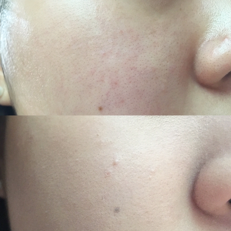 Before&After

보시면 한 겹만 발랐을 뿐인데도 홍조, 트러블이 말끔히 커버된 게 보이시나요? 보통 파운데이션을 바르고 손으로 만지면 지문자국이 나기 마련인데 이 제품은 바르고 난 뒤 피부에 딱 붙어버리고 보송하게 변해서 마치 모공파우더를 발라준 느낌이었어요ヽ(*´∀｀)

이번 여름 파운데이션은 엑스퍼트 퍼펙트 핏 파운데이션에 정착 해야겠어요!! 이제 외출할때 파운데이션이 흐를 일은 없게 되었어요!!!!!! 꺄 넘 좋네요,,,

혹시 여름 파운데이션 고민중이신 분들이 계시다면 가까운 VDL 매장에 가셔서 테스트 해보세요😊


그럼 우리는 다음 리뷰에서 또 만나요╰(*´︶`*)╯