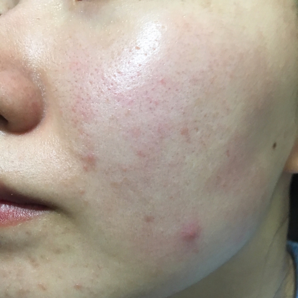 토너로 피부결만 정리한 피부에 시카겔을 도포해주었어요!



확실히 속부터 차오르면서 피부에 보습을 주더라구요!



겔이라고해서 너무 가벼운 타입이지 않을까 했는데 

크림만큼은 아니여도 적당한 무게감이 있어서 오히려 저는 좋았어요!☺️