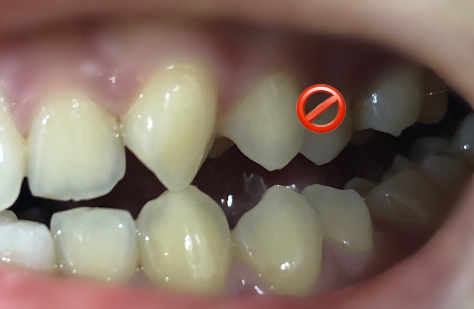 양치 전 치아
식사 후라 좀... 하하 수치스러워서 가렸어요...😅
치아 색이 누런 것도 좀 부끄럽네요😭