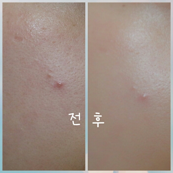 반대편 트러블이 난곳에 발라주니 완벽하진 않지만 붉은기도 많이 잡아주더라고요~회복크림이라 트러블이 난곳에 발라도 걱정이 안되더라고요~