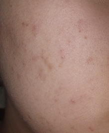 지금 제 피부상태에요..ㅠㅠ 진짜 피부 볼때마다 너무 슬퍼서 요즘 기초 케어만 엄청 단단하게 하고있어요!! 여기에 바세린 시트 마스크팩을 사용해볼게욤! 이 바세린 시트 마스크팩은 10분정도 해주고 떼어내면 된다고해욤!! 떼어낸 후 에센스를 피부에 흡수시켜주면 된다고 사용방법에 적혀있어요!! 