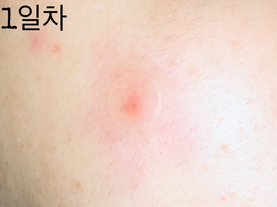 상처 부위를 가볍게 씻고 중앙부터 부착해 줍니다

트러블이 조금 크게 생겨서 12mm짜리 부착했어요!

투명하고 무광처리 되어있고 얇은 테두리로 밀착력이 우수해요

뛰어난 접착력으로 지속력이 우수하고 생활방수 기능까지 있어요