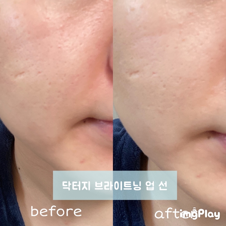 위의 사진으로 톤 업효과를 제대로 못 보여드린거 같아서 따로 준비해봤어요 (ง •̀_•́)ง 

닥터지 브라이트닝 업 선 사용 모습 입니다

사진을 보시면 확실히 톤 업 효과를 보실 수 있지 않나요? 
얼굴 노란끼와 붉은끼를 잡아주고 자연스럽게 톤 업이 되어서 가까운 곳에 나갈때도 빠르게 바르고 나갈 수 있는 제품이에요! 그리고 톤업 지속력은 4~5시간은 보통으로 유지되는거 같아요(๑ ˃̵ ᴗ ˂̵)و 
