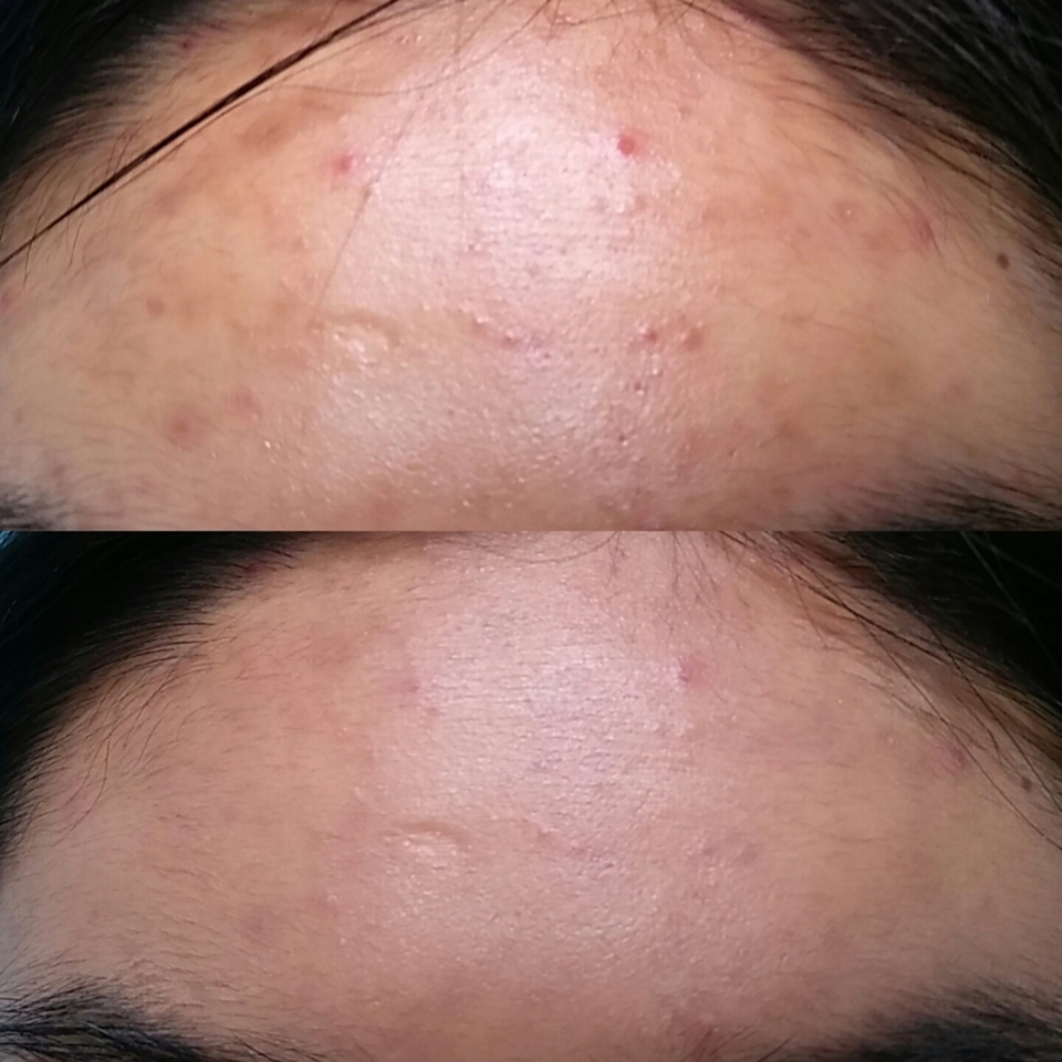 대망의 이마... 진짜 쨩이예요.. 커버력!! 컨실러로도 회색으로 남는데 거의 다 가려브렸숩니댱.. 저는 중요한 날에 거의 이 파데바르구 있어요!! 추천드립네다🐵🚶


제 리뷰가 유용하셨다면🐴
좋아요❤ 팔로우❤ 부탁드려요~