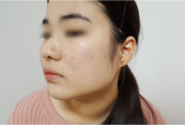 트러블피부는 두썹지않고 얇게 바르시는게 좋아요! 저는 전체적으로 얇게 두드리며 바르고 트러블이 심한 곳만 한번더 얇게 도포했습니다!