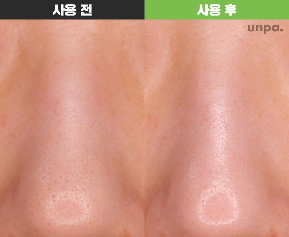 스팀 수건으로 피지를 불려준 다음
사용하면 효과가 좋다고 후기를 듣고
똑같이 해봤더니 어머...♥

블랙헤드가 옅어진 게 눈에 보이더라구