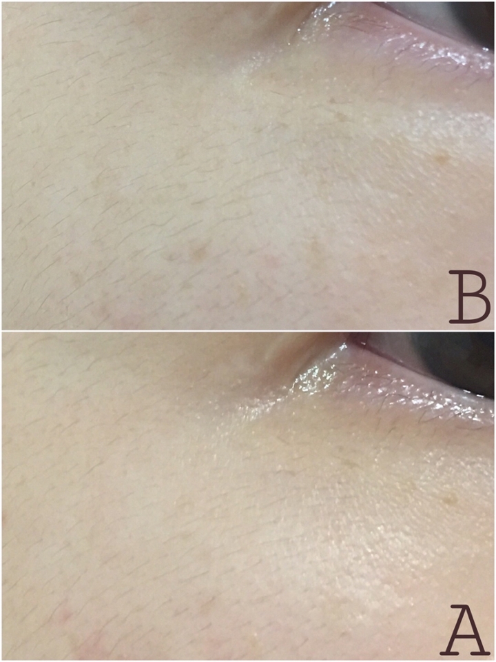 보정 하나도 안한 필터도 안씌운 현실 사진입니다

저는 기미가 눈가에만 생겨서 기미가 있는 부분에는 항상 더 도톰하게 발라줬어요

왼쪽 눈가 사진이고 위에가 비포 아래가 에프터 입니다!

🚨비포 사진은 이 제품 개봉하기 전날 찍어놨던 사진이고 에프터 사진은 잡티세럼 본품 2개 공병만든 날 찍은 사진이에요🚨