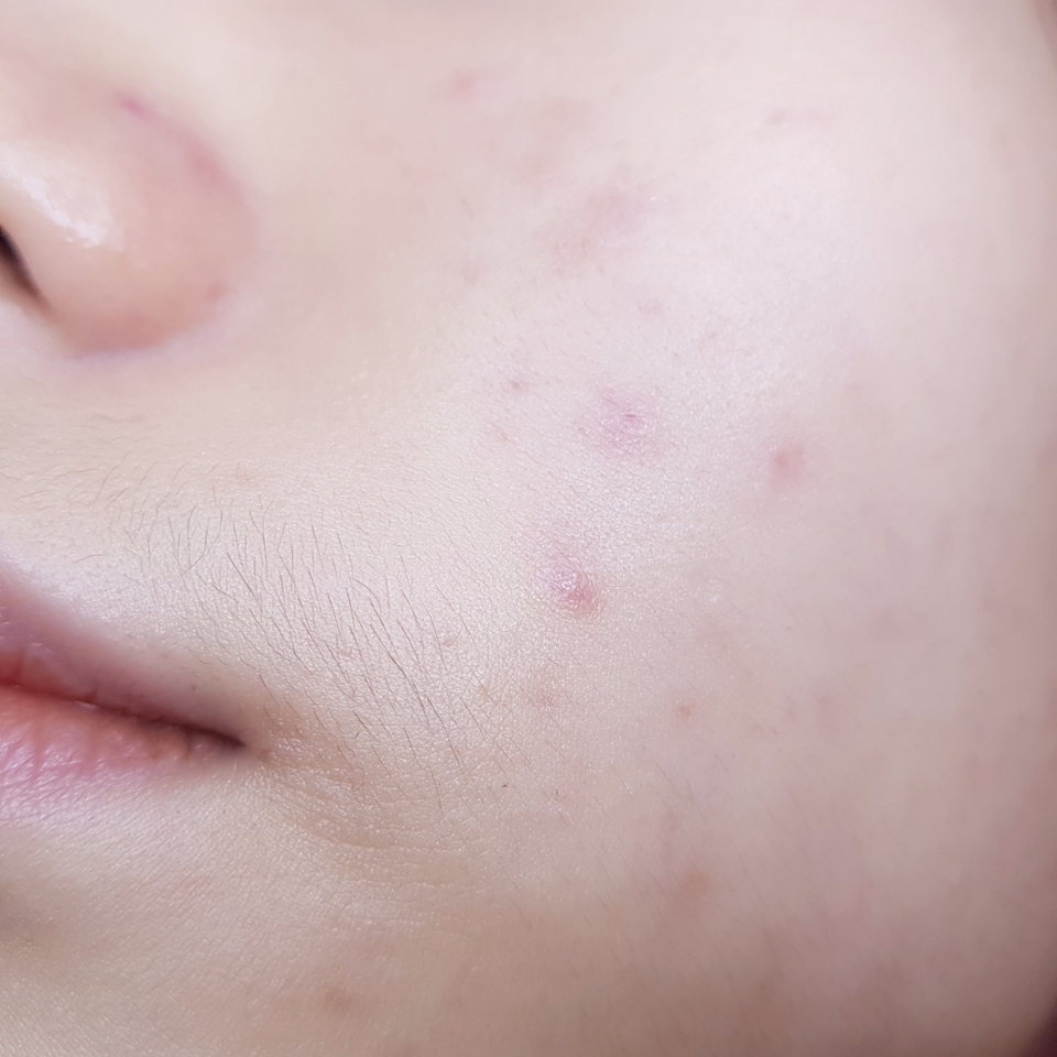 비벨벳 커버 쿠션 사용 전 피부에요.
화사한 컬러감의 쿠션이라 사용 전에 가볍게 톤업크림만 발라줬어요!
​
트러블 잡티들, 코 옆과 트러블 주위 붉은끼들, 입술 근처 거뭇거뭇한 착색들...
한 마디로 개판인 피부에요 (^人^)
​
저는 22호 피부톤이라서 차분해지고 싶을 떄에는 23호, 화사해보이고 싶을 때는 21호 제품을 사용하는 편이고
피부가 건조해서 주름이 쉽게 생기고, 그러다 보니 주름 사이사이에 베이스들이 쉽게 끼게 되더라고요.
또 매트 쿠션은 스킨케어를 아무리 촉촉하게 해줘도 완벽하게 들뜸없이 밀착시키는데에 한계가 있는 피부에요!
