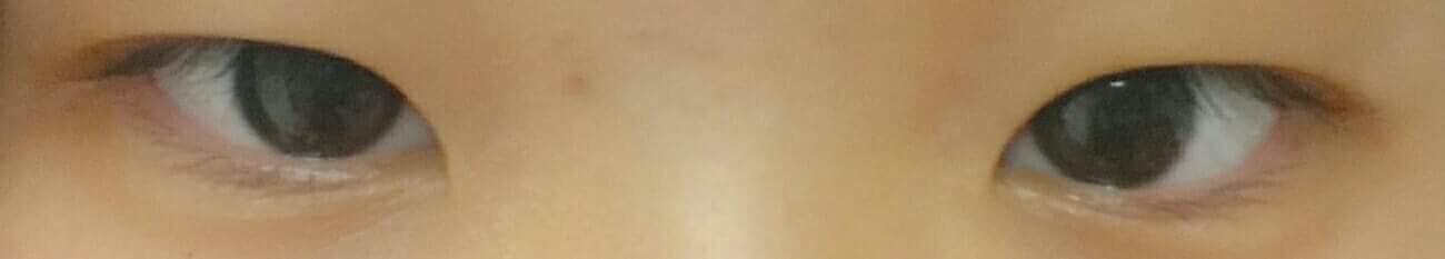 제일 중요한 쌍수전 ! 거의 2년내내 쌍액을 달고 살았습니다 ㅜㅜ.... 쌍수하기전 거의 2주 3주정도 쌍액 안하고 다녔어요 ! 증말로다가 편하더라구요 ...^^
