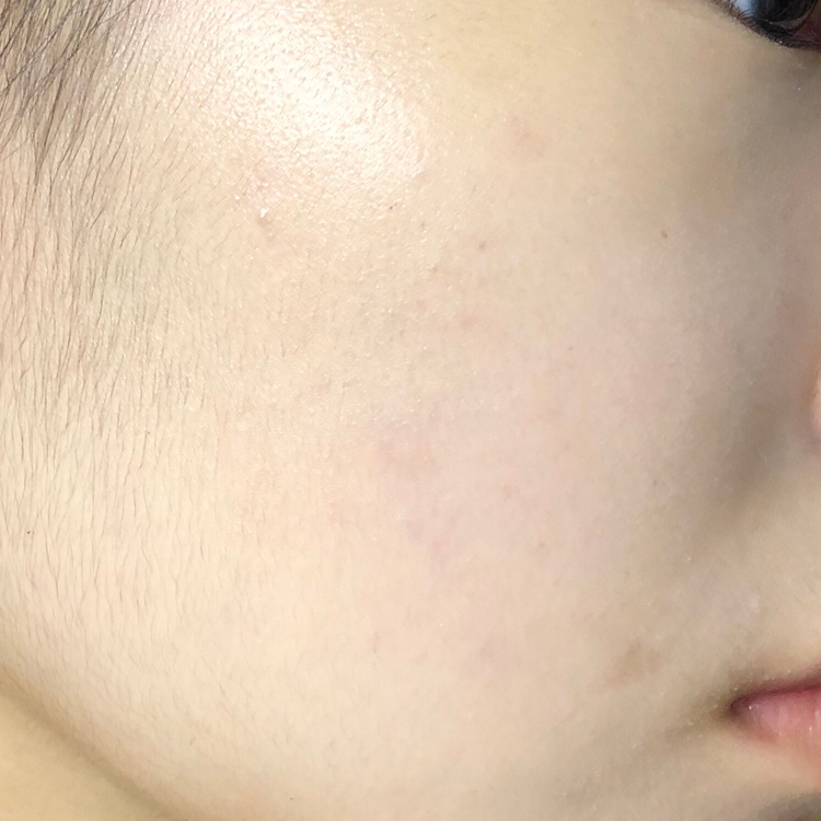 붉은끼뿐만 아니라 잡티도 많이 가려지신 것 보이시나요! 정말 좋았어요 쿨링감도 있어서 딱 여름에 바르기 정말 좋을꺼 같아용!