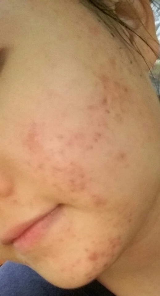 세안후 입니다! 세안하실때 모공브러쉬로 얼굴은 문떼줘요~그럼 안에 뭉친 밀가루가 없어집니다~모공브러쉬가 없으신분은..깨끗이 행궈주심 되요~!! 저는 이팩을하고나서 여드름이 많이 없어지더라구요 볼에 잇는 건 여드름 흔적입니다ㅠ 이팩하시고 피부좋아지세요!