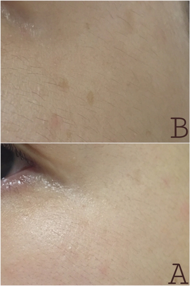 이번에는 오른쪽 눈가 잡티 사진이에요

왼쪽, 오른쪽 모두 잡티가 완벽하게 없어지지는 않았지만 그래도 사진으로 비교해서 보니 눈에 띄게 많이 옅어졌죠..!

광고하는것 처럼 2주만에 빠르게 잡티를 완벽하게 없애기는 어려웠지만 꾸준~~히 사용하면 확실히 잡티는 옅어진다는것! 
하지만 피부톤이 환해지거나 미백효과는 못봐서 조금 아쉬워요

저처럼 잡티가 고민이신 분들께 추천드릴게요!

현재는 아이소이 잡티세럼II 사용중인데 아이소이꺼 공병 만들고 구달 청귤세럼과 비교하는 리뷰도 올리도록 할게요!! 

리뷰 봐주셔서 감사합니다🍊