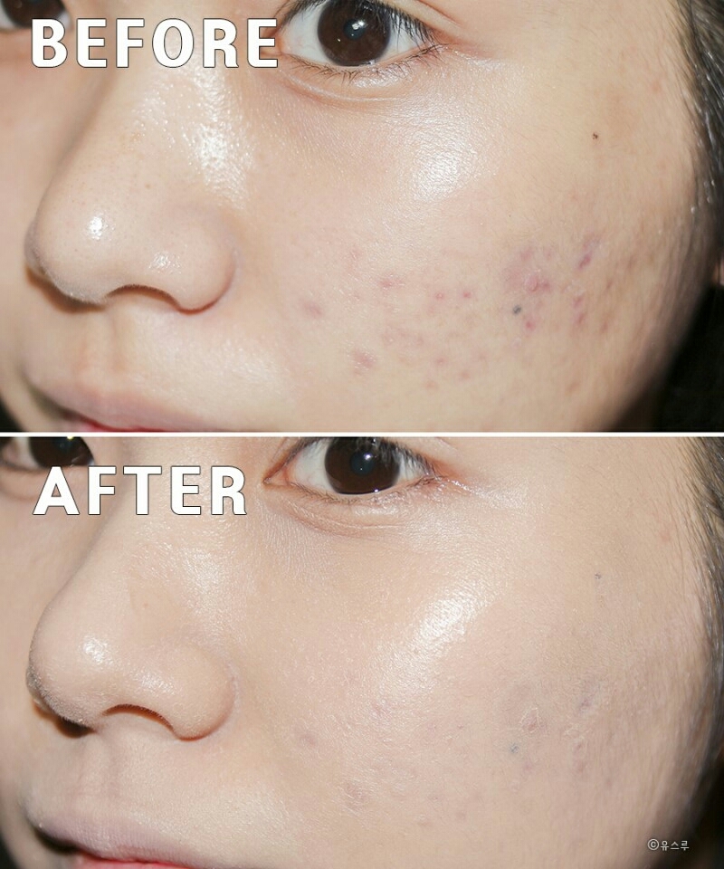 그리고 비포 & 애프터 ♡

징챠 매끈하게 커버되었죠?
색상도 굉장히 자연스러워서 입술 허연거
아니면 모를정도..!

그치만 프라이머 기능까지 하는 제품이라 그런가 굉장히 매트해요ㅠ

각질 부각 쩜...;;