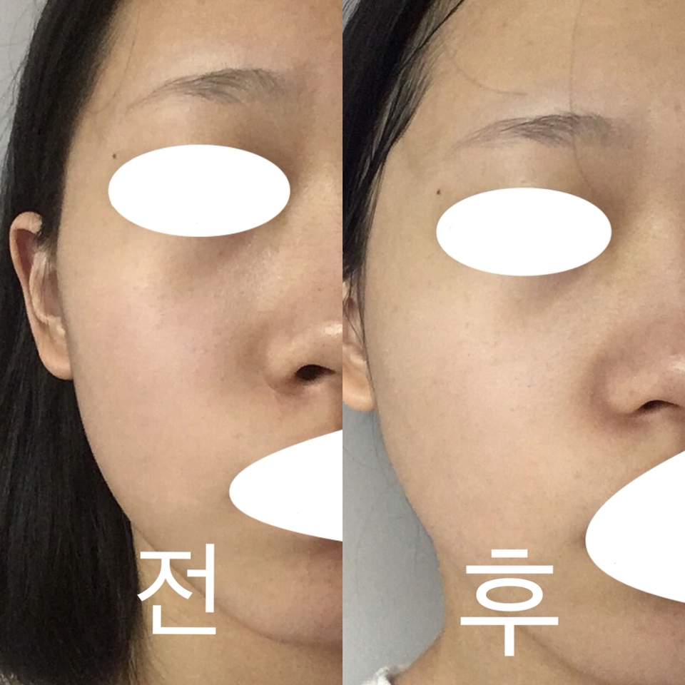 전후사진이에요 둘다 무보정인데다, 같은 장소 같은 형광등 조명 아래서 찍은 사진인데 피부가 확실히 환해졌어요 코옆 들뜨는 각질도 가라앉았어요

지금까지 제이준 블랙 물광 슬리핑 팩 리뷰였습니다 봐주셔서 감사해요!