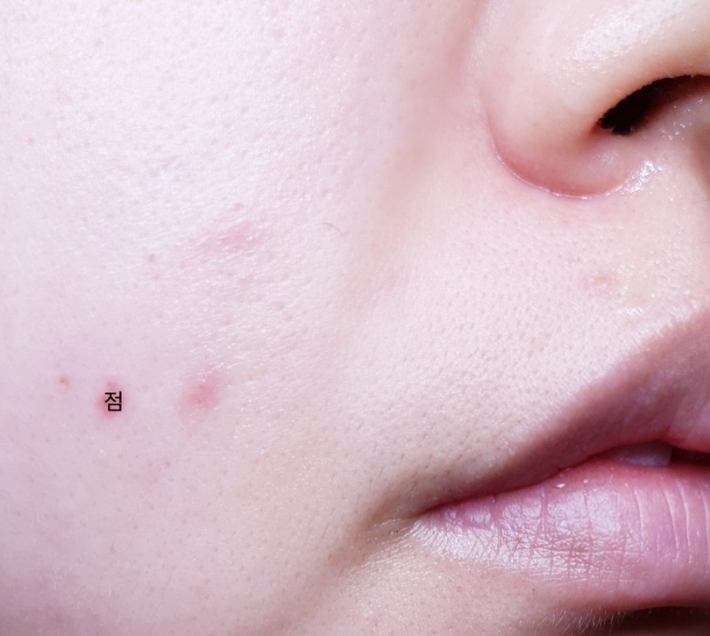 발라준 다음날 모습이예요
큰 흔적들이 촉촉하게 케어되고

아문거 보이시나요??

사실 저 자국들이 5일이나 된 것들인데

흔적이 지워지지않아 맘고생이 심했거든요ㅜㅜ

(짜지나말던지...내자신아...)

​

