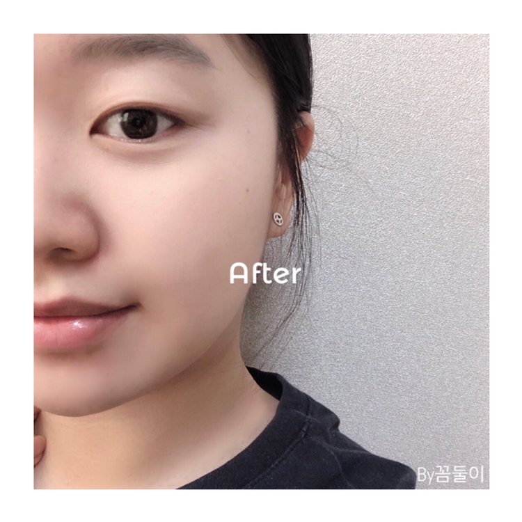 ✨짜짠✨

어떤가요? 정말 보정 안했습니다! 왜냐 효과는 확실해야허니까 ! ㅎ 볼빼고 다른부분은 좀 ㅎ 했죠 부끄러우니깡


효과는 !😉😉
주근깨와 홍조 트러블자국은 거의 가려지는 편이고
점은 아무래도 진하다 보니 반정도만 가려지는 것 같습니다! 
이정도면 성공적인 컨실러죠? 😆

그리고 장점들이 있다면

컨실러는 보통 무겁게 느껴지는데 가볍고 얇게 펴발라져서 컨실러만 사용해도 괜찮다 느낄 정도 이구요 

피부가 건조하신분들은 매트하다고 생각 되실 수 있을 것 같아요 그래도 촉촉하게 발리고 나중에 밀착 되다보니 좋은거 같아요! 



🥰이상 꼼둘이의 솔직한 파워 리뷰 였습니다! 🥰


이니스프리로부터  무료 제품을 받아 솔직하게 작성된 리뷰 입니다.
