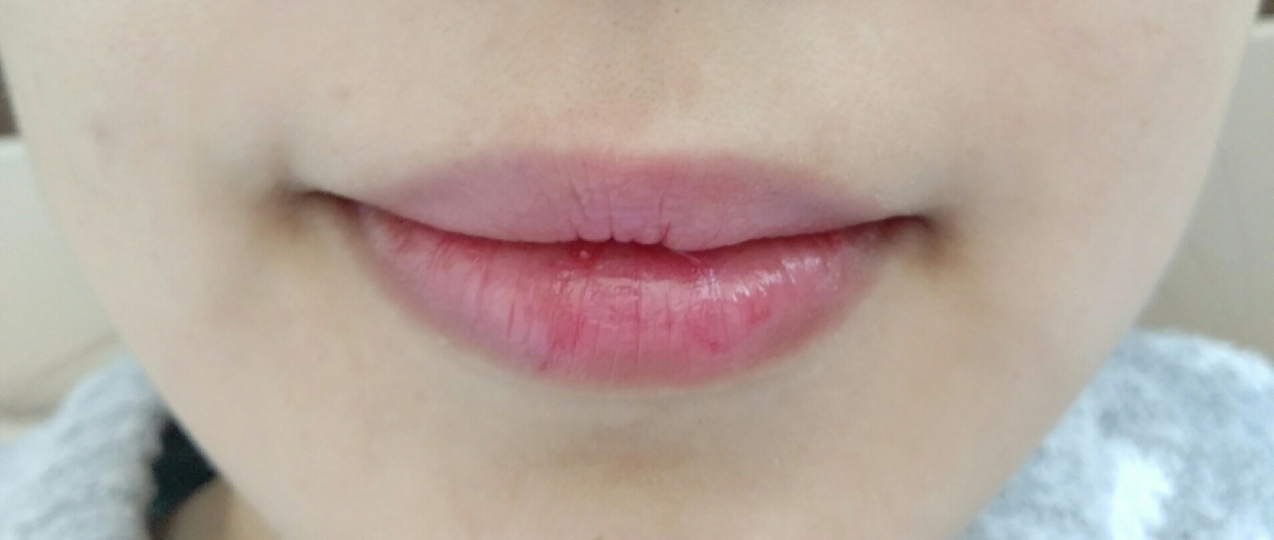 여기에 틴트립밤을 발라주었어요 ㅎ
립컬러가 아니라서 색이 진하지 않고 입술에 생기를 주는데요~^^ 

전 그래서 학생분들에게 추천하고 싶어요 . 

자연스럽지만 그렇게 발색이 약한 편은 아니라서 평상시에 가뿐히 사용하기 좋아요 😊

이사한 제 집 방 조명이 밝은 편이라
사진이 좀 더 밝게 나온 것 같아요ㅋ