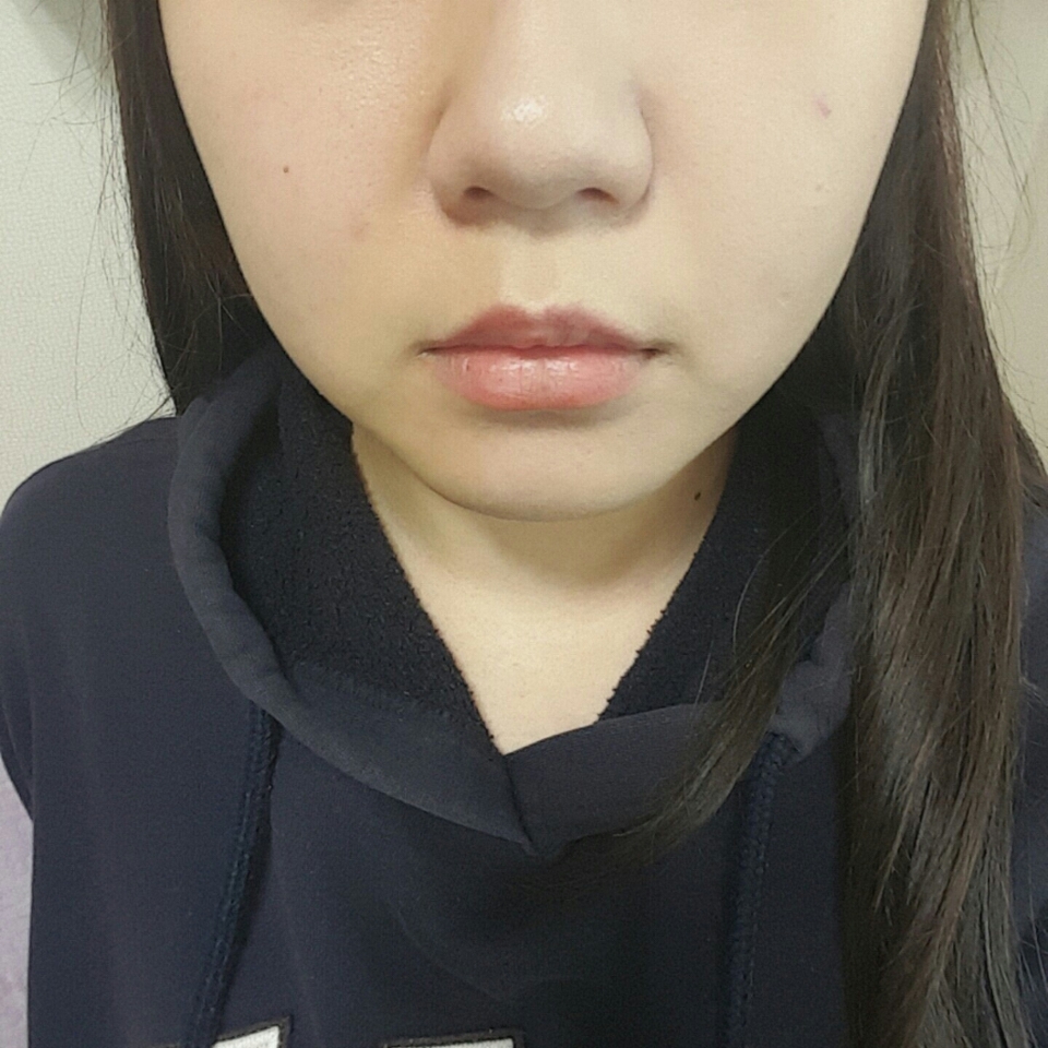 얼굴의반만 발라봤습니다! 피부톤보정 잘잡아주고 촉촉하고 커버도 꽤 괜찮아요
물론 저렇게 큰 트러블은 컨실러로 잡아줘야하겠죠😭