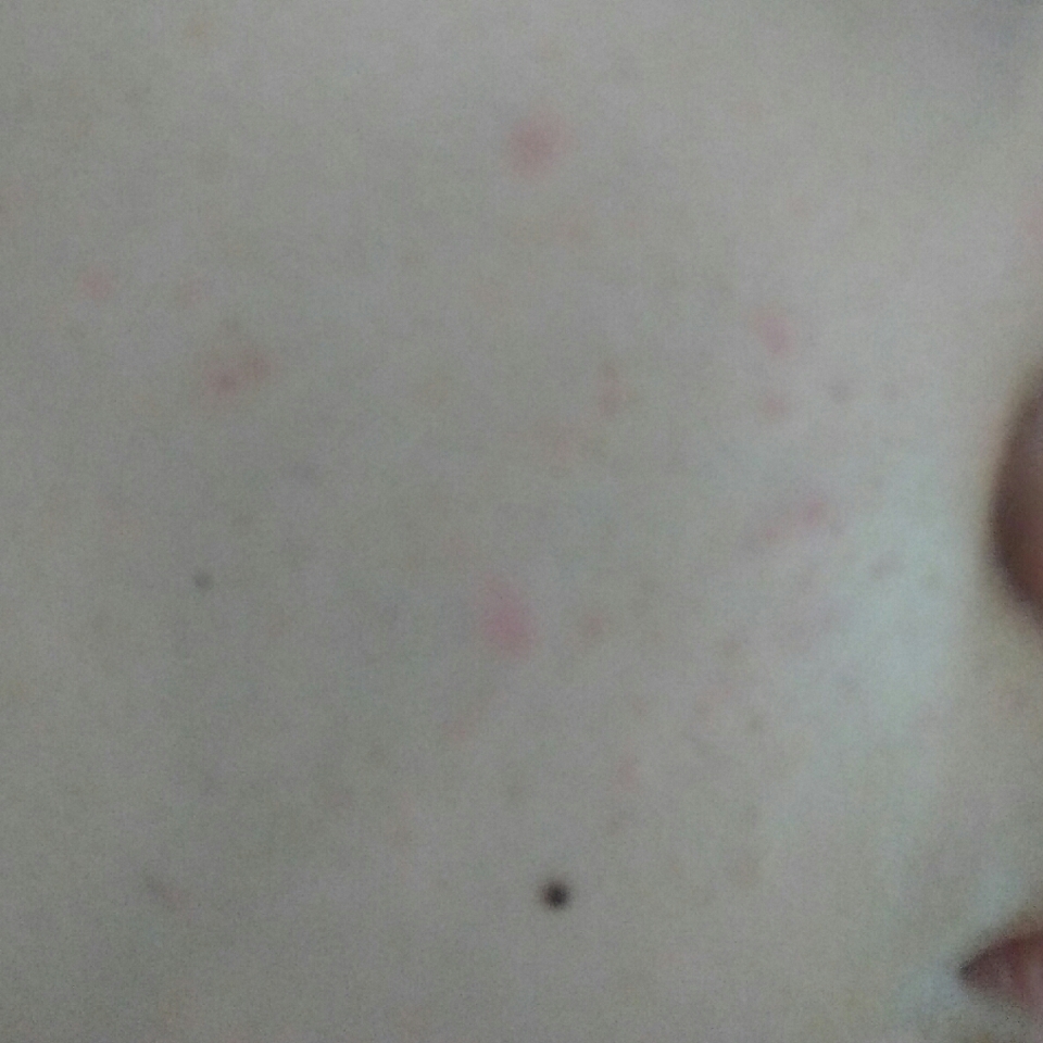 3주정도 쓰니깐 여드름 싸악 없어지고 왕드름이들 흉터가 연해지고 있어요 ㅜㅜㅜㅜ 진짜 캡쨩!