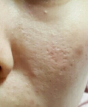 

위에서 한 케어로 몇 달 후가 이 사진!
까맣고 붉은 흔적이 좀 나아졌죠?


이 때부터는 EGF 앰플보다 제가 쓴 진정케어 루틴들을 사용했어요.

한 1년~2년동안 이벤트+내돈내산으로 EGF 앰플
계속 사서 썼는데 그게 5개+재생크림이 정가가 50?40?만원이고 저는 대폭 할인 때만 샀는데 그게 22~24만원이라 월급 중에 생활비 빼고 화장품비는 거의 앰플에만 쏟아부었어요.

좋긴 좋은데 인간적으로 너무 비싸기도 하고
현재는 단종이라 어차피 못 사기도 하고
그 때야 옛날이니 (한 4~5년 전) 그렇지 요샌 기초퀄리티가 워낙 높아져서 🚫나쁜성분 🚫안맞는성분 만 거르고 EGF 함량 높은 앰플 아무거나 쓰셔도 돼요.
(아! 그래도 후기는 확인!)


