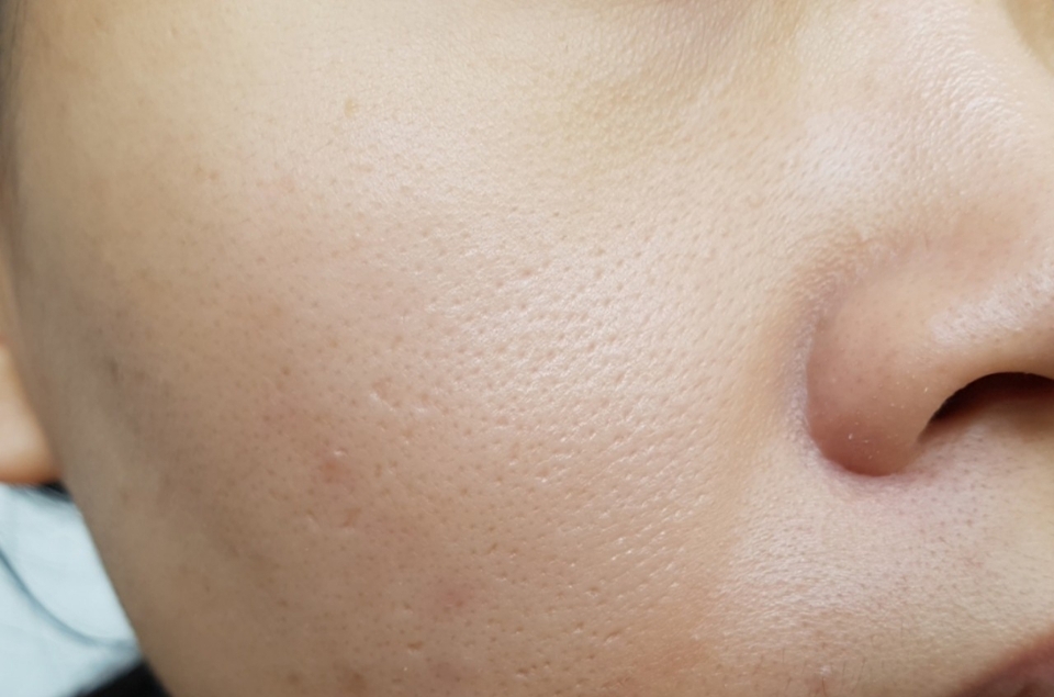 
가장 중요한 건 얼굴 위에서의 사용감이겠죠?

먼저 기초케어와 선크림 까지만 바른 제 피부에요. 
모공이 심한 편이라서 평소에는 포어 프라이머를 사용하지만, 
제품의 커버력을 확인하기 위해서 
정말 기본적인 단계까지만 했어요. 
​
제 피부톤은 22호이며,  
평소에 21호에서 22호 제품을 사용하고 있었기 때문에 
고민 없이 21호 라이트 베이지를 픽-❤
​

