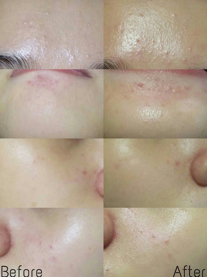 효과는 딱히....오히려 패드가 좀 자극적이여서 별로좋지않았어요 오른쪽이 애프터입니다...ㅠㅠㅠ