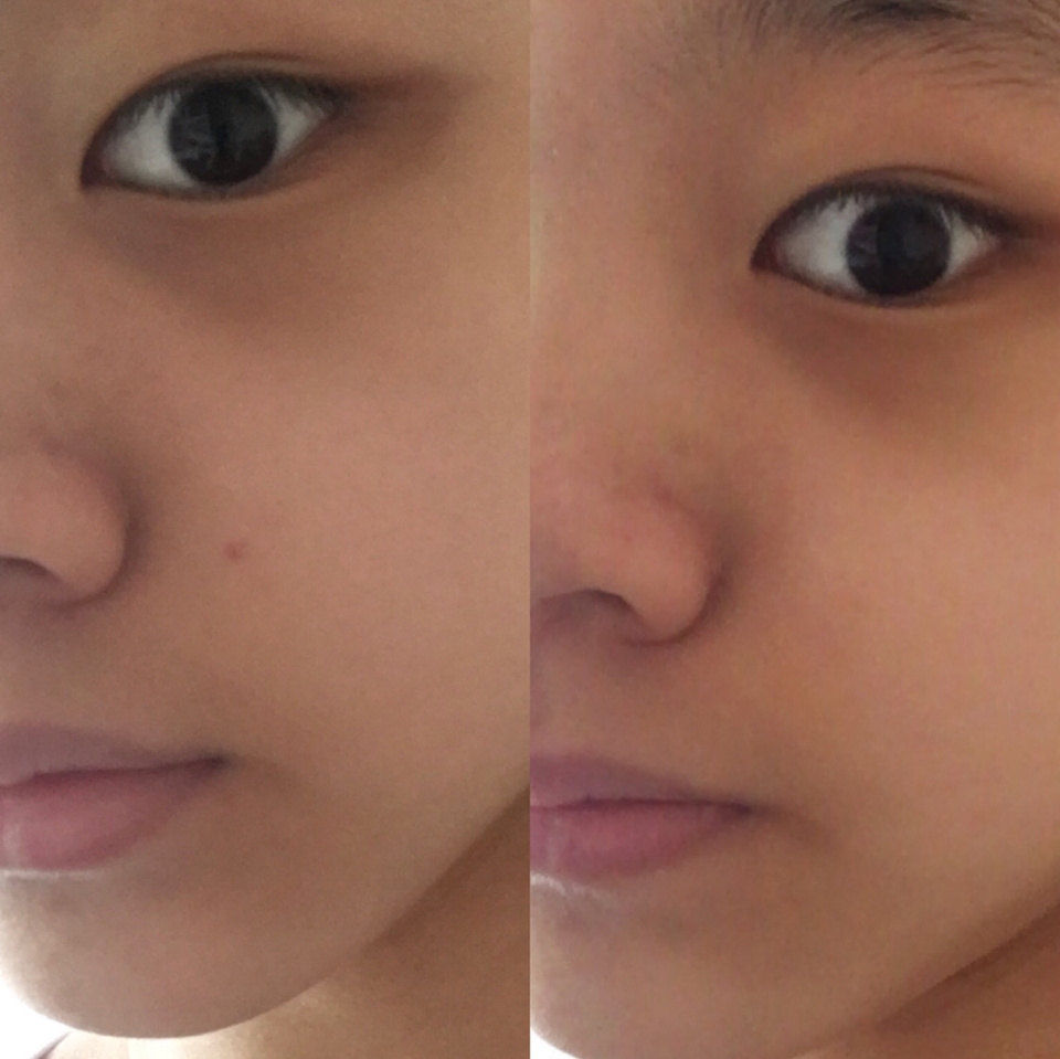 이번에는 비포와 애프터 사진을 한 번 가져와 봤어용

왼쪽이 바르기 전, 오른쪽이 클렌징젤을 바른 후에요:)

여드름이 좀 진정되고 가라앉은 느낌이 들어요 ㅎㅎ

한번에 좋아지지 않지만 꾸준히 사용하면 여드름 개선과 

피지에 좋을 것 같다는 생각이 들어요 ..! 이 클렌징은 쿨링감

이 마음에 들어요 !! 뭔가 클렌징 젤을 바르고 나면 묘하게 

피부가 시원하고 말끔해진 느낌이에요 !!

