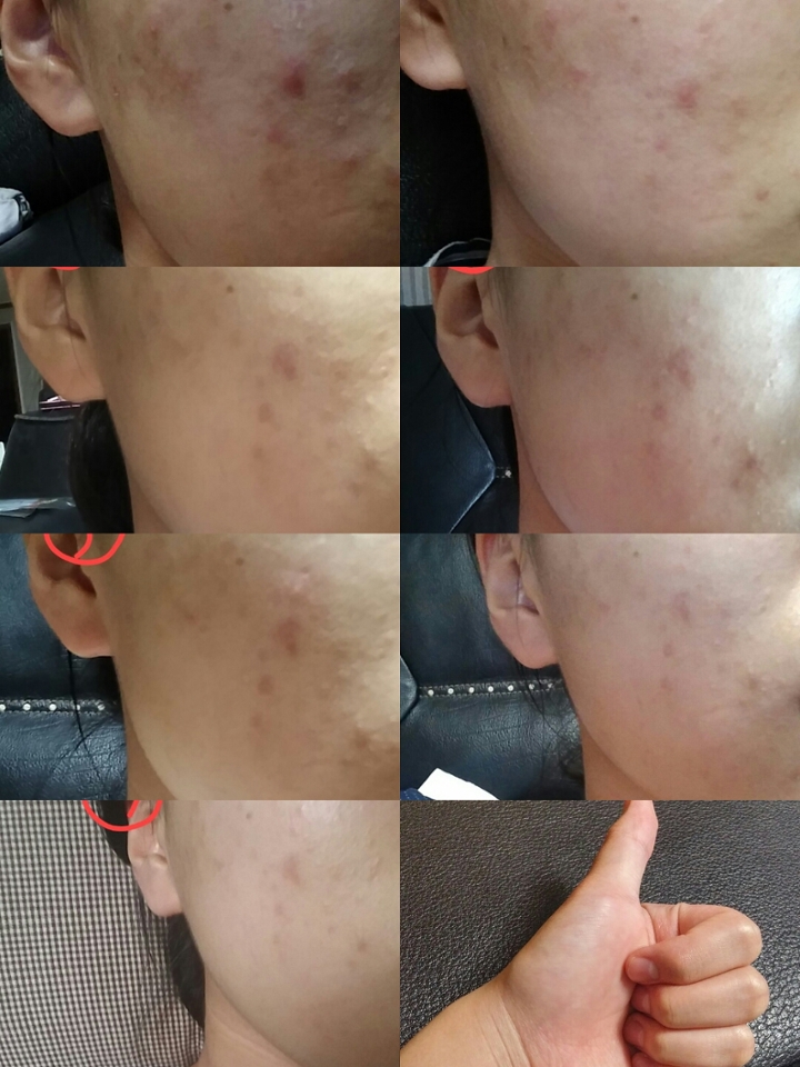 1 2
3 4
5 6
7
하루에 두번씩도 하고 한번씩도 했었습니다 2~3번째가 가장 효과를 많이 봤어요~ 그리고 약간의 화이트닝도 있는것같아요:)