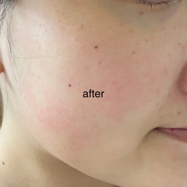토너 사용한 후 사진입니다.
 사용하기 전이랑 거의 차이점이 없지만 피부가 좀 촉촉해지는 게 느껴졌어요!
 평소 물같은 제형의 토너만 사용해봤는데 약간의 점성이 있는 토너로 수분을 보충할 수 있다는 게 신기했어요😄
