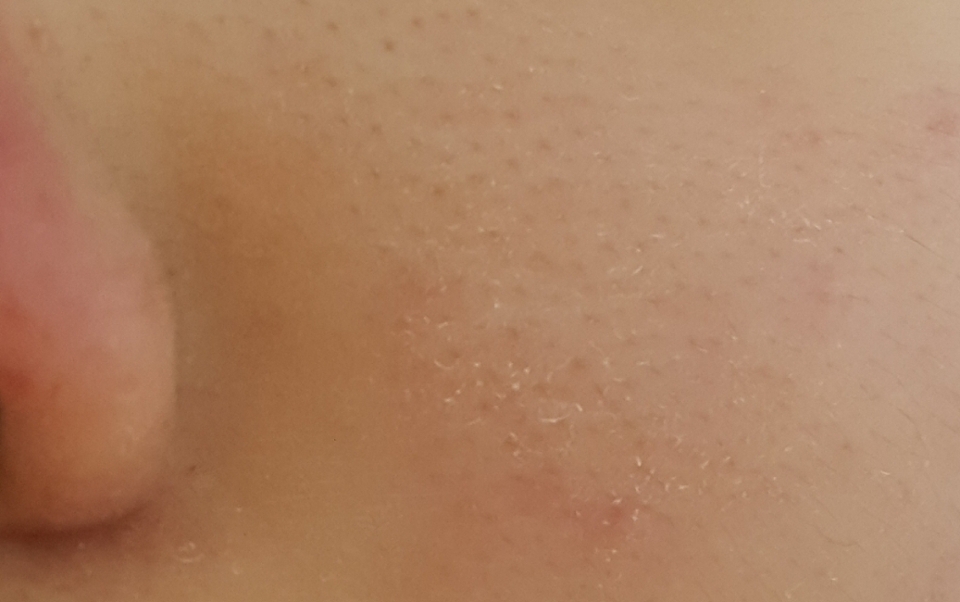 

사용하기 전입니다! 바로 전에 어퓨 딥 클렌징 폼을 사용하고 왔는데요 메이크업 클렌징 용으로 나온 제품이라 그런지 세정력이 세서 쉽게 수분이 날아가는데요 특히 저는 #수분부족형지성 이라서 이렇게 강한 제품을 쓰면 이렇게 각질이 일어난답니다 한눈으로도 각질이 심하게 일어난거 보이시죠!

