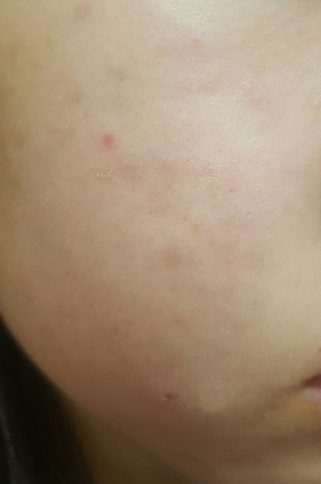 토너을 바르기 전 뒤집어진 제 피부입니다ㅋㅋㅋㅋㅋㅋㅋ노답..