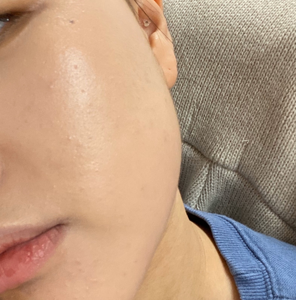 빠꾸없는 커버력 ㄷ ㄷ ㄷ 근데 이게 한 번 얇게 깐거라는거
커버력도 좋운데 가볍네 ? 근데 안매트해 ! 광이 너무 예뻐 !!! 
이 사진 하나로 커버력은 충분히 설명됐다고 봅니다요! 제가 생각하는 커버력의 기준은 컨실러 안하고도 나갈수 있느냐인데 요거 사용한 날에는 컨실러 안해요 ~! 완전 큰 흉터같은 건 루나 컨실러 사용해서 가려주능데 요즘 귀찮아서 걍 안씁니다 ㅎㅎ 이쯤되면 걍 난 루나 발닦개 ,,,, 사랑해 루나,,,