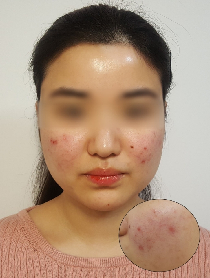 확실한 차이를 위해 평소 히님히님과 같은 고민을 가지고있는 친구를 섭외하였습니다!