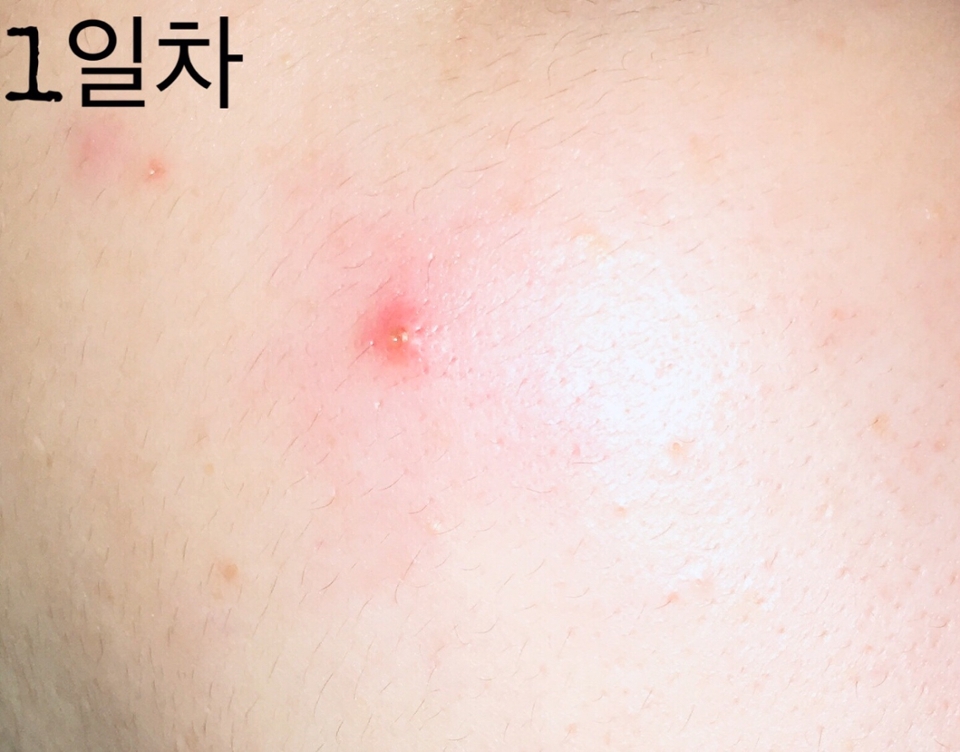 트러블이 올라오기 시작하는 단계라서 트러블 주변이 빨갛에 부어 올랐어요😢

이미 터진 상태였고 투명한 딱지가 앉았길래 패치가 필요한 때였어요