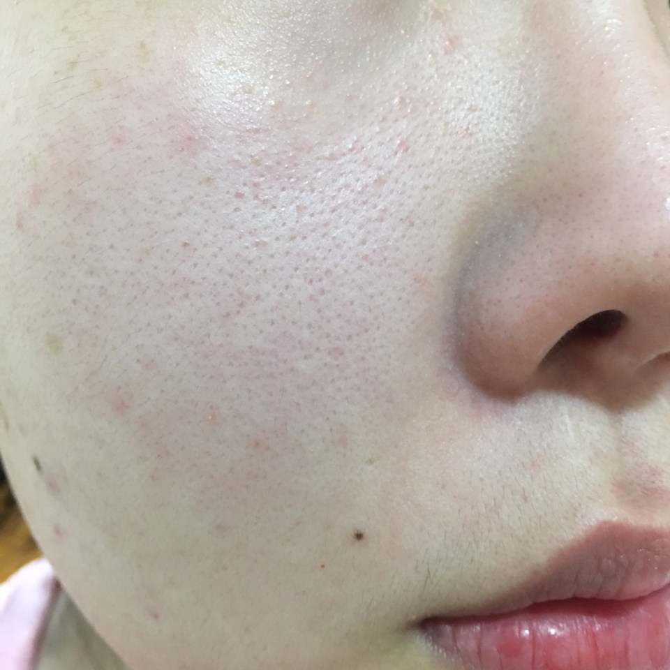 에프터 사진!! 
시트 제거 후 미온수로 얼굴 전체를 헹궈내고 스킨케어 사용 전 단계에 바로 찍어봤어요 
단 1회 사용만으로 모공이 많이 수축되었고 블랙헤드도 사용 전 보다 많이 옅어졌어요 
모공 속 노폐물도 쏙쏙 빠졌구요~
이런 쬲템을 사놓고 방안에 쳐박아뒀다니...
주기적으로 사용하면 효과 정말 많이 볼것 같아요 
지금 막 사용해보고 거울보고 깜짝 놀라서 바로 올리는 리뷰입니다
사용전과 눈에띄게 달라진 모공때문에 신기해서 지금 거울보며 감탄중이에요ㅜㅜ
모공케어가 필요한 언니들 당장 사용해보세요!!!!