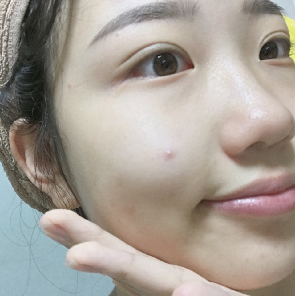 꾸준히 사용하면 저기 뾰루지도 사라지겠죠?ㅠㅠㅠ 요즘 환절기라 그런지 피부가 난리이네요ㅠㅠ 여러분도 꼭 이 토너패드 사용해보세요!