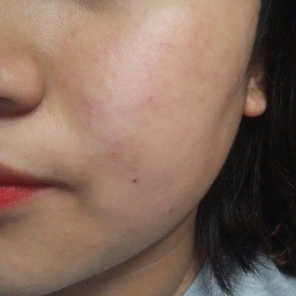 여드름 많은 얼굴을 커버해 보겠습니다