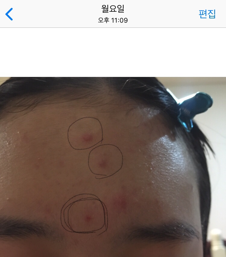 하루전)
여드름이 나고 바로 시카플라스트밤을 발라봤어요 !
저는 여드름이 나도 짜지않는편이라 냅두는데 세수하다가 가운데 여드름에 진물이 나와서 좀 더 붉어보여요
그리고 위에 두 여드름은 볼록 튀어나오고 붉었어요 !
