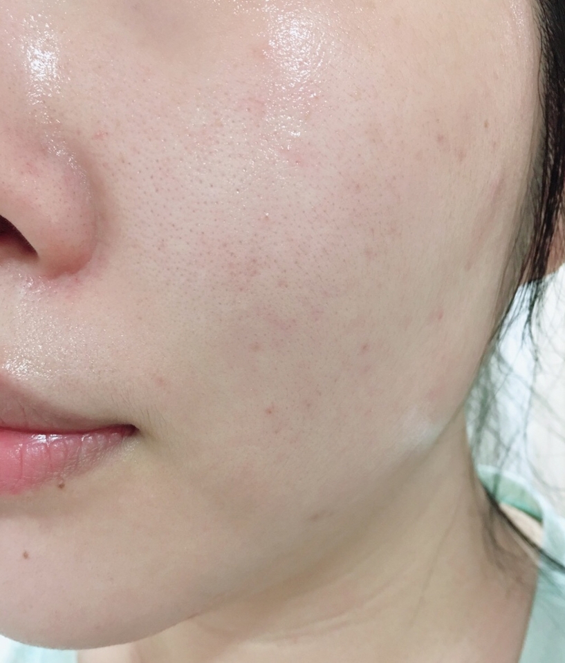 3회 펌핑해서 잡티 부분에는 여러번 덧바르고 얼굴 전체에 발랐어요

이게 기능성 제품이라 보습 부분에서는 전혀 기대하지 않았는데 의외로 수분감이 많이 느껴져서 수부지 피부인 저는 다른 제품을 따로 덧바르지 않아도 충분했어요

마무리는 끈끈한 느낌이 있지만 피부에 흡수가 될수록 끈끈한 느낌은 점차 사라져요

앞서 얘기했듯 비타민C 성분은 빛, 열, 공기에 약해요
그래서 보통 비타민c가 함유된 화장품은 낮에 바르면 안된다고 생각하시는 분들 많이 계시죠
비타민c가 햇볕에 노출되면 산화가 일어나는데 이 과정에서 피부가 더 어두워질 수 있으니까요

하지만 요즘은 자외선과 외부환경에 강한 🌟안정화된 비타민c🌟 제품들이 많이 나오고 있는데 바로 이 제품이 안정화된 비타민c 유도체를 함유했다고 해요
즉, 아침, 저녁 발라도 괜찮습니다!!

저는 이 세럼이 “안정화된 비타민c” 라는거를 공병만들고 난 후에야 알게되어서 저녁에만 사용했지만.. 이미 쓰고계시는 분들이 계신다면 오전에도 걱정없이 바르셔도 괜찮아요!!
그래도 자외선 차단제는 필수라는 사실..!!