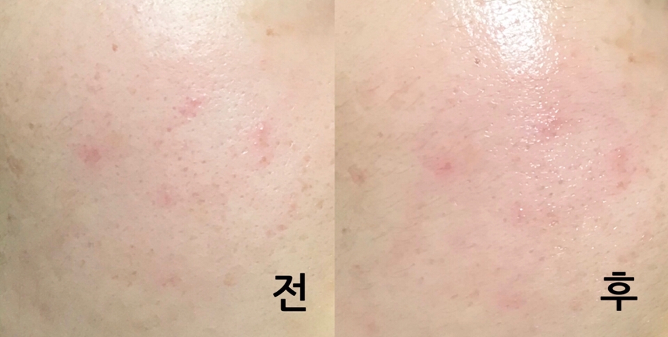 [전]

세안을 막 마친 민얼굴이에욥 보기만해도 건조하쥬? 

하루종일 화장하고 다녀서인지 불긋불긋 올라온 곳이 보여요. 세안을 이중으로 하기 때문에 세안 직후엔 더 건조힌거같아융,,,, 

암튼 맨피부임미다! 여기에 크림스킨을 화장솜에 적셔서 5분정도 팩처럼 붙여뒀어욤!


[후]

화장솜 뗀 후에요, 바로 윤기가 챠르르륵 돌아요! 
일단 로션이면 윤기가 돌아야 하는게 당연한거니까욤
그치만 뭔가 스킨만 바른거치고는 저 윤기와 쫀쫀함이 오래갔던거같아요! 크림(색)스킨 이상이었나바여,,ㅎㅎ

암튼 정말 스킨으로 크림 역할까지 할 수 있는 ,,,
일타 이피의 크림스킨이지만 
전 뭔가 ㅠ 그냥 스킨 로션 둘다 발라야 바른거같꾸...
건성이라서 저거 약간 수분감 부족하구...
일단 저거 너무 안나오구... 

그래서 그냥,,,, 쟁여뒀다가 날잡고 스킨팩 용도로 쓰려구욤,,,, ㅎㅎㅎㅎㅎ 


마무리를 또 어떻게하져,,? 
그럼 다음에 또 봐욘 (*☻-☻*)

